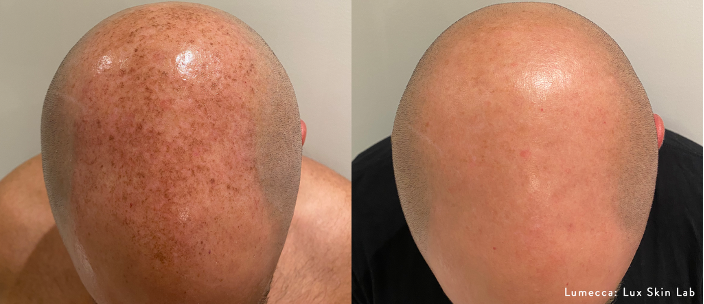 Lumecca Peak, antes e depois