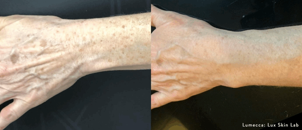 Antes e depois do tratamento Lumecca para remover manchas solares na pele das mãos.