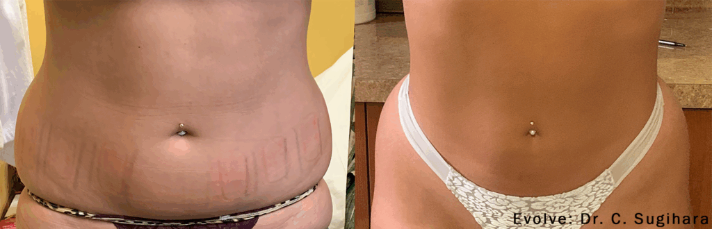 Resultados antes e depois de eliminar a celulite