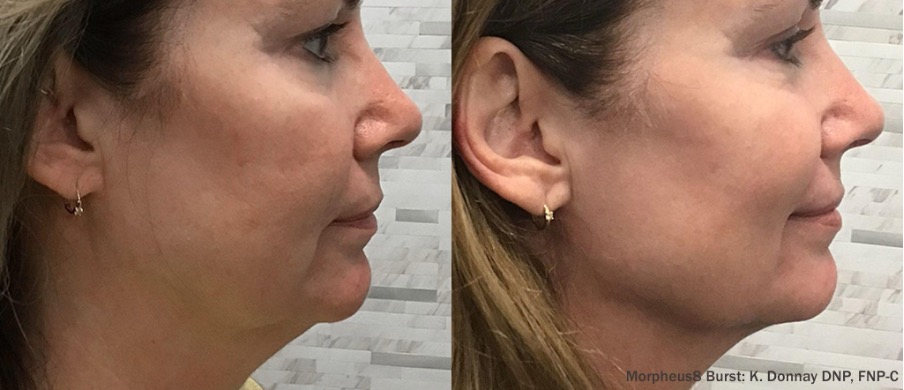 Rejuvenescimento facial sem cirurgia com Morpheus8 Burst