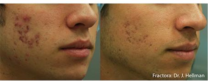 Fractora InMode para cicatrizes de acne