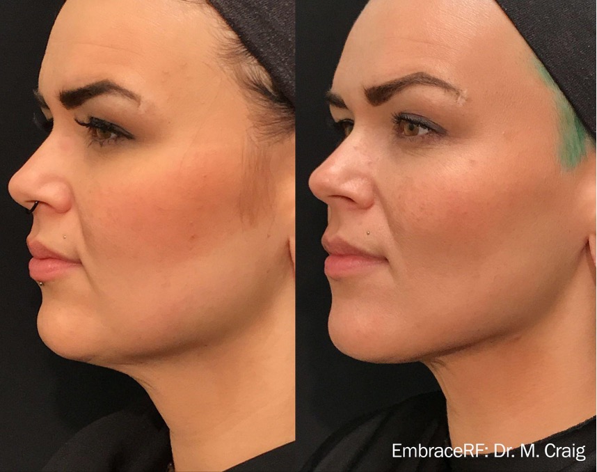 EmbraceRF InMode para redefinir o maxilar