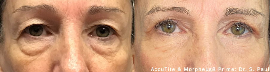 AccuTite e Morpheus8 Prime para pálpebras descaídas