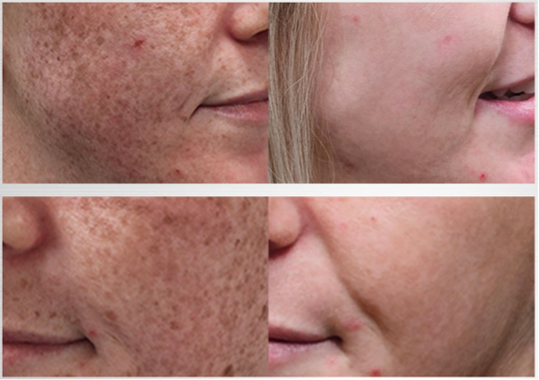 Antes e depois, resultados do Lumecca Peak