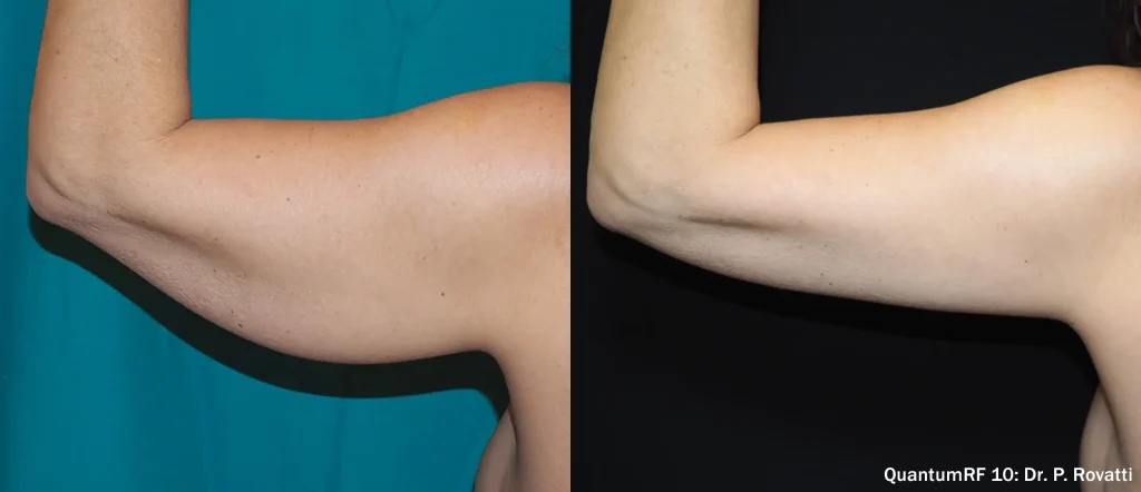 lifting de braços antes e depois