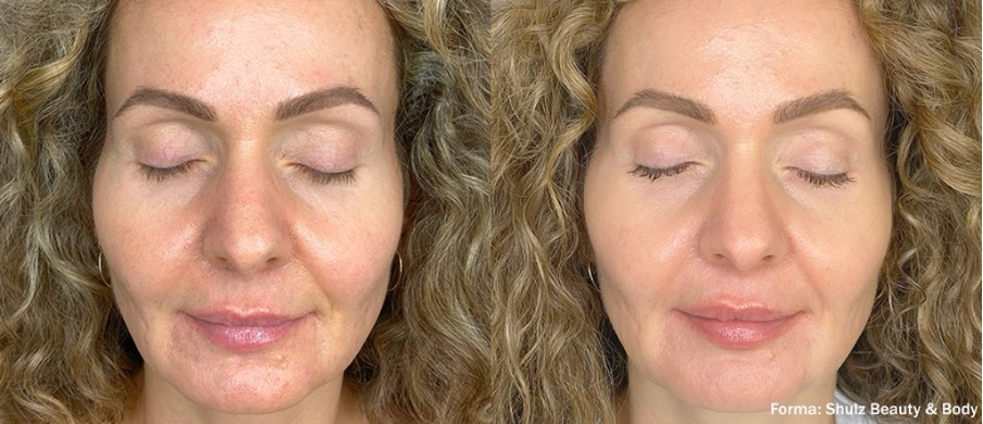 Luxora: Forma para el rejuvenecimiento facial.