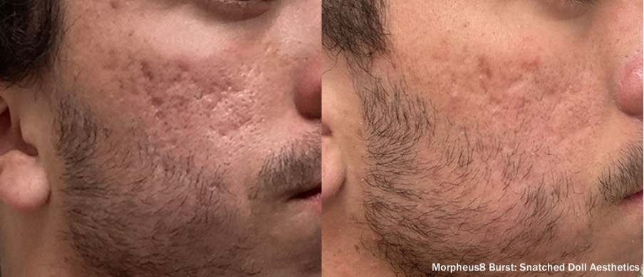 Luxora: Morpheus8 Burst para o rejuvenescimento facial