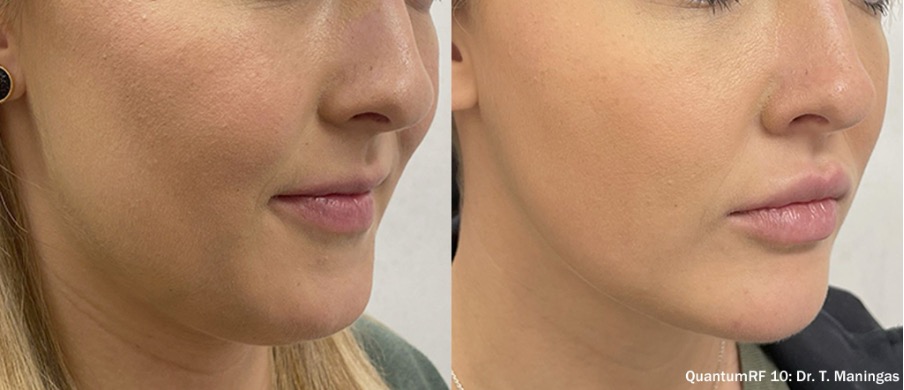 Luxora: QuantumRF 10 para o rejuvenescimento facial