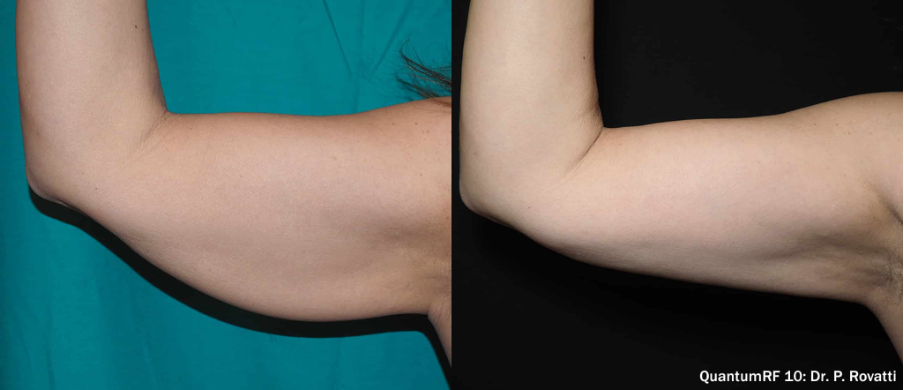 antes e depois QuantumRF 10
