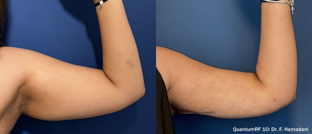 antes e depois QuantumRF Inmode