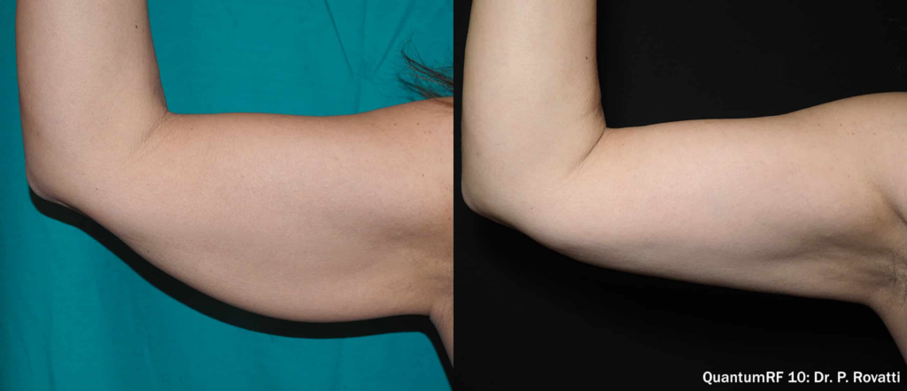 antes e depois QuantumRF Inmode