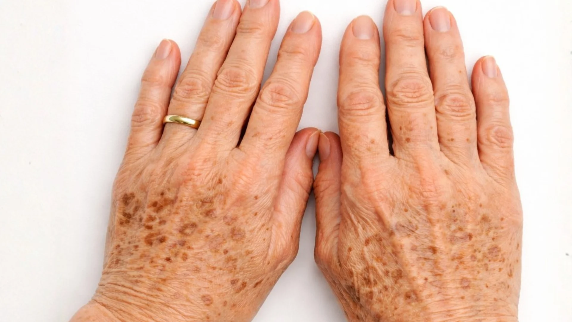 como tirar manchas solares da pele com Laser Q-Switched