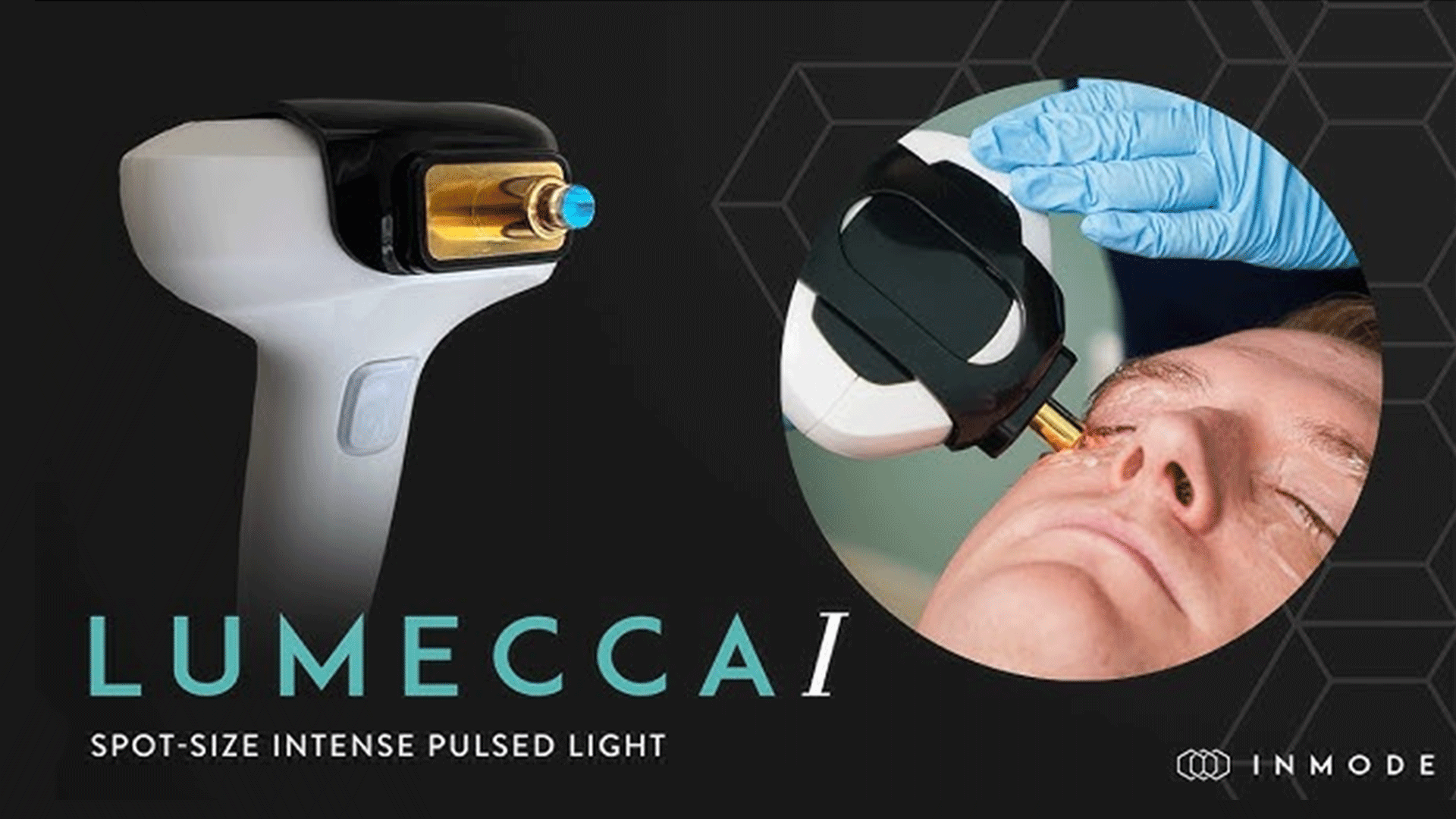 Lumecca-I: Utilização da Luz Pulsada Intensa para o controlo da inflamação ocular e da rosácea ocular