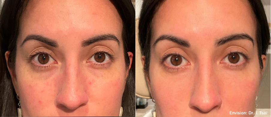 Antes e depois Envision