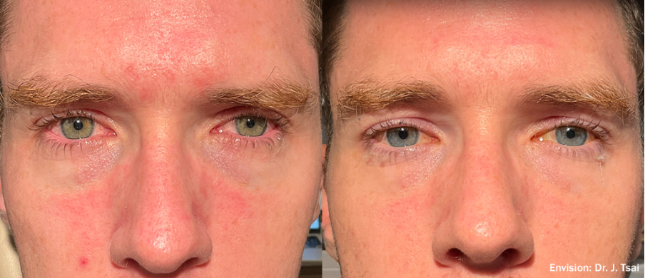 Antes e depois Envision by InMode