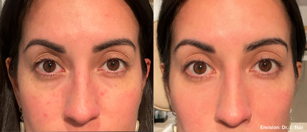 Antes y después Envision