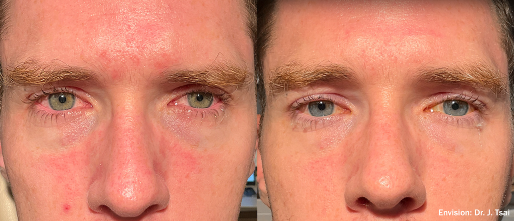 Antes y después Envision by Inmode