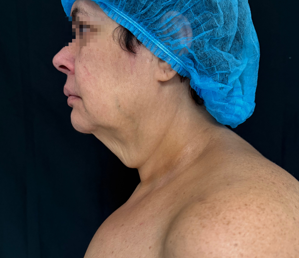 Lumecca Peak: Tratamento IPL de nova geração