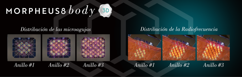 Morpheus8 Body 3D: a remodelação corporal do século XXI