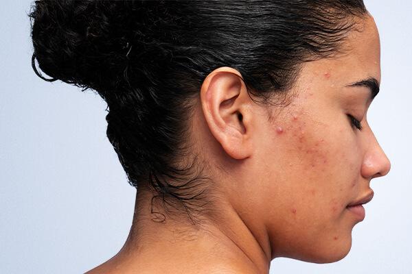 Como remover cicatrizes de acne