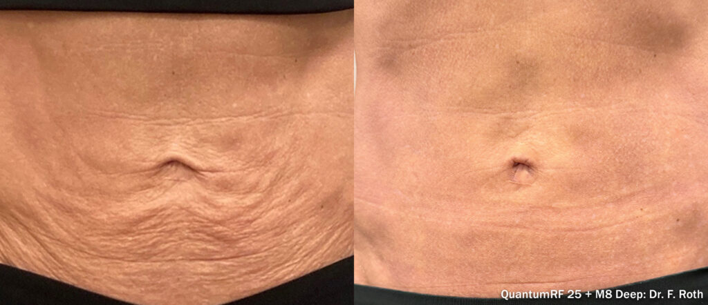 Antes e depois BodyFX Pro