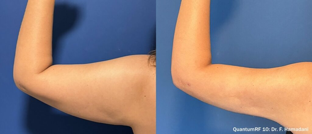 antes e depois QuantumRF InMode