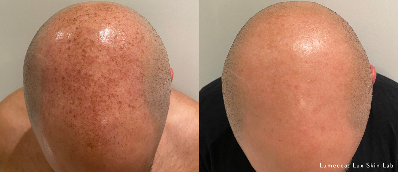 Tratamento estético com EvolveX para tonificação muscular não invasiva.