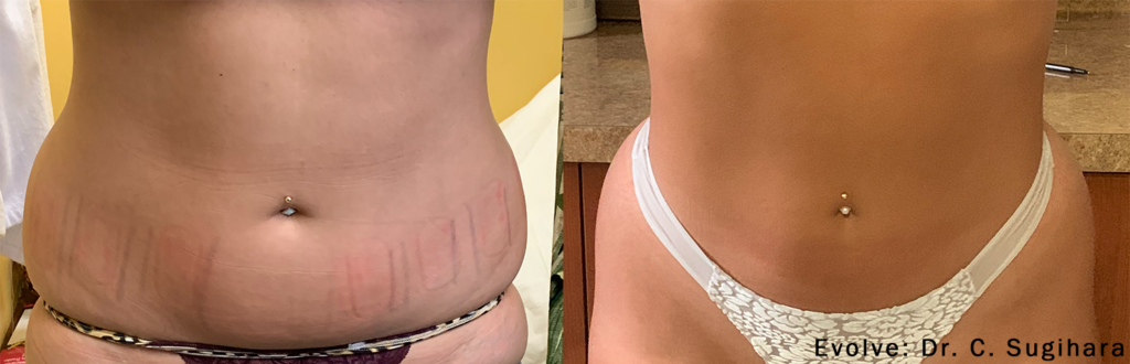 Resultados antes e depois de eliminar a celulite