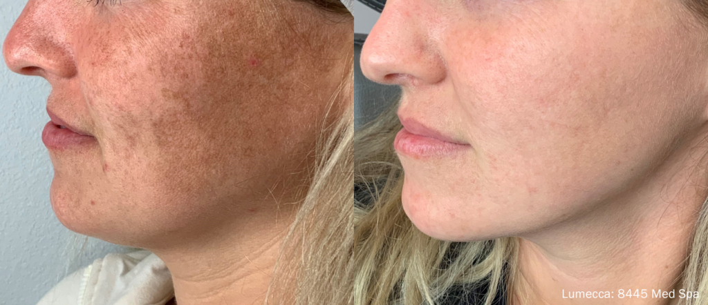 Antes e depois do fotorejuvenescimento facial no rosto.