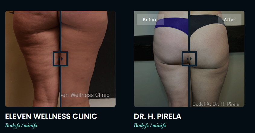 Exemplos de resultados de contorno corporal com as tecnologias BodyFX e Morpheus8 Burst