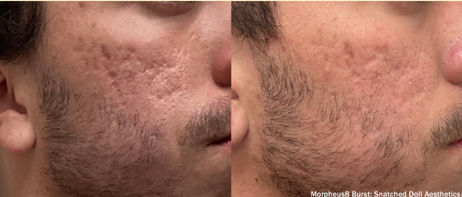 Antes e depois com Morpheus8 Burst: o que esperar realmente sessão após sessão